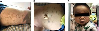 Case Report: Mucopolysaccharidosis Type I Treatment With α-L-Iduronidase Replacement Therapy